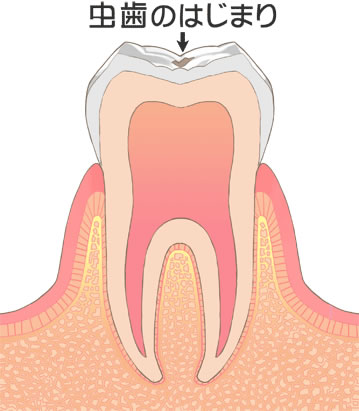 虫歯治療
