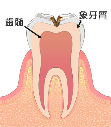 虫歯治療