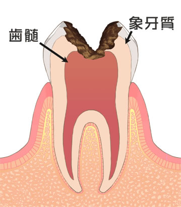 虫歯治療