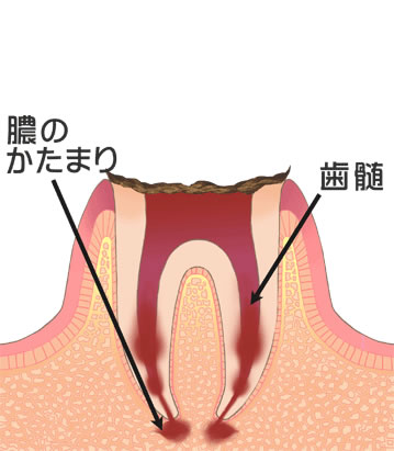 虫歯治療